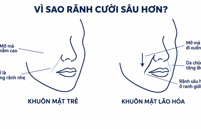 Rãnh cười sâu hơn có thật sự là do thiếu collagen?